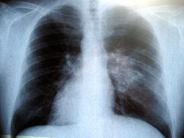 lungs