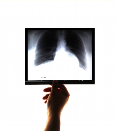 lung x ray